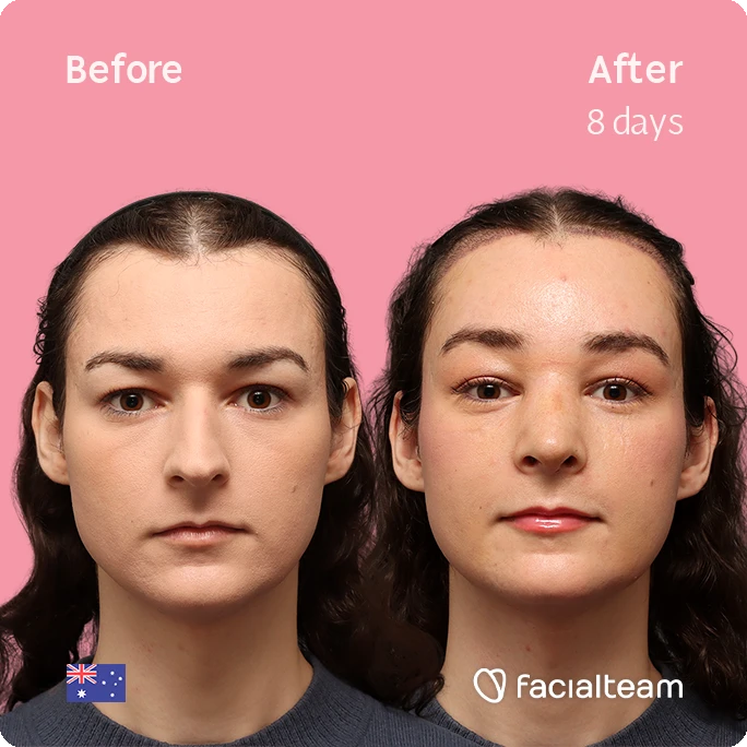 Before and after comparison of a woman's face: left side labeled 'Before', right side labeled 'After 8 days', showing clearer skin and reduced redness against a pink background; logos and flag watermark visible.