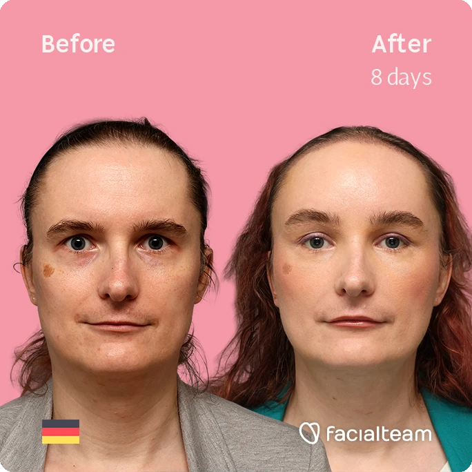 Side-by-side photo of a woman's face before (left) and after 8 days of treatment, showing smoother skin and improved complexion; brand Facilateam logo and German flag.