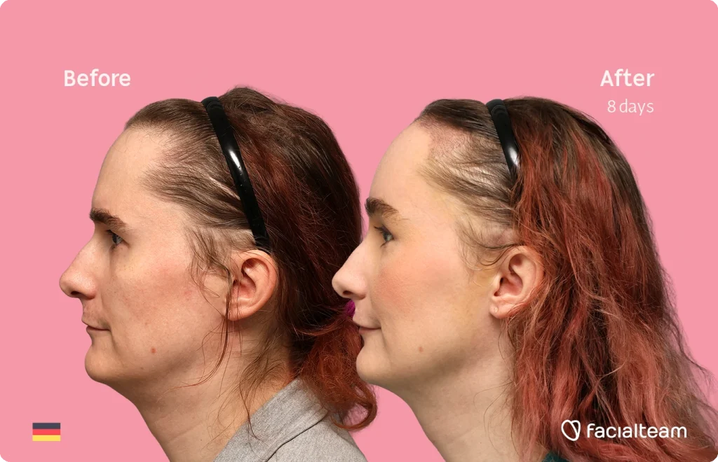 Side-by-side profile of a woman's head labeled 'Before' and 'After 8 days', showing a subtle facial change against a pink background. FacileTeam logo in corner.