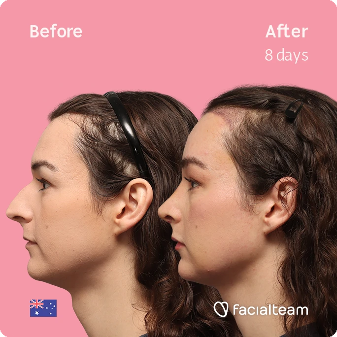 Side-by-side profile photos of a woman before and after 8 days of treatment, highlighting a slimmer jawline on the right; pink background with Facialteam logo.