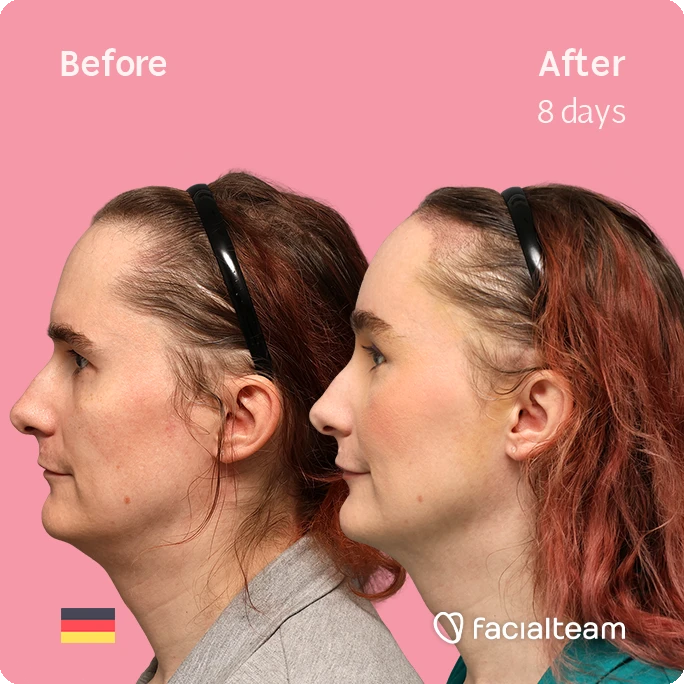 Before and after side profiles of a woman eight days after a cosmetic treatment, showing a slimmer jawline and smoother neck.