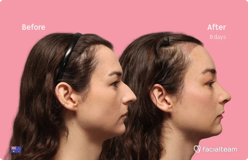 Side-by-side profile of a woman before and after a treatment on a pink background, with 'Before' left and 'After 8 days' right, and the facialteam logo.