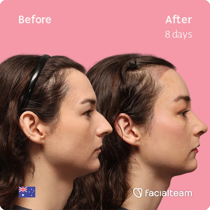 Side-by-side profile of a woman before and after treatment, pink background, labeled 'Before' and 'After 8 days' (facialteam watermark).