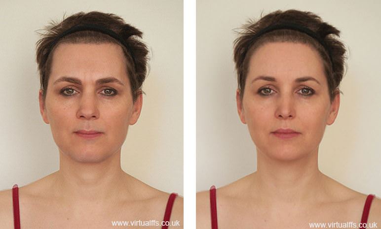 Facial Feminization App