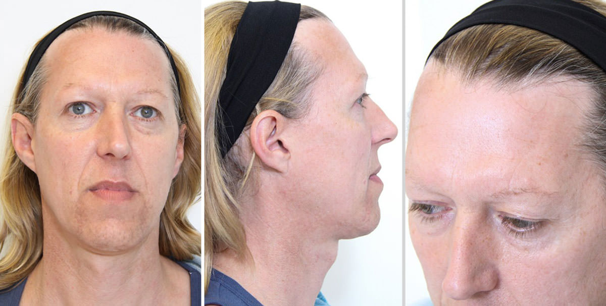 Facialteam, World Leader in Facial Feminization Surgery