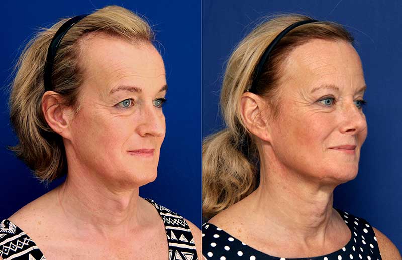 SCAR-FREE, UNIFIED APPROACH TO FACIAL FEMINIZATION