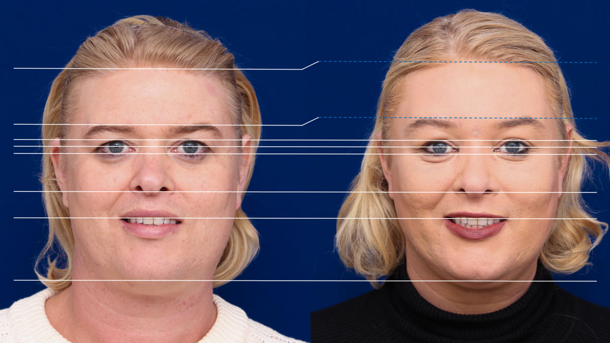 Facialteam - Facial Feminization Surgery
