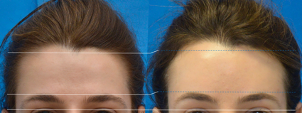 Facialteam - Facial Feminization Surgery